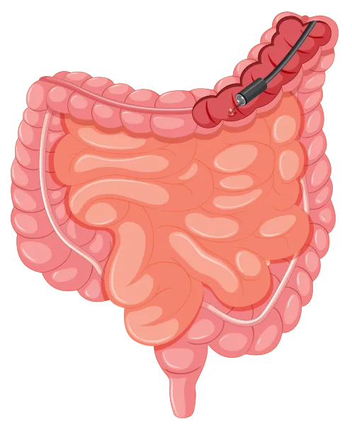 Imagen ilustrativa de laparoscopia, tracto digestivo y colon por dr. Omar Herrera